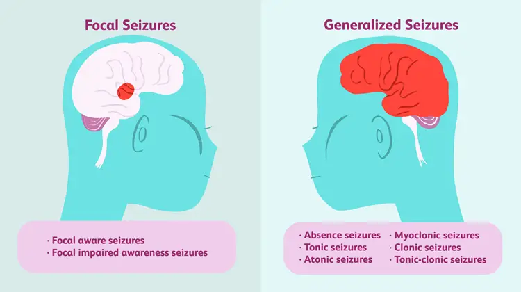 Seizures In Children Types