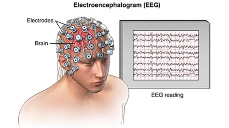 eeg for epilepsy