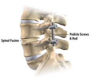 Permanent Restrictions after Spinal Fusion - What Do the Doctors Say?