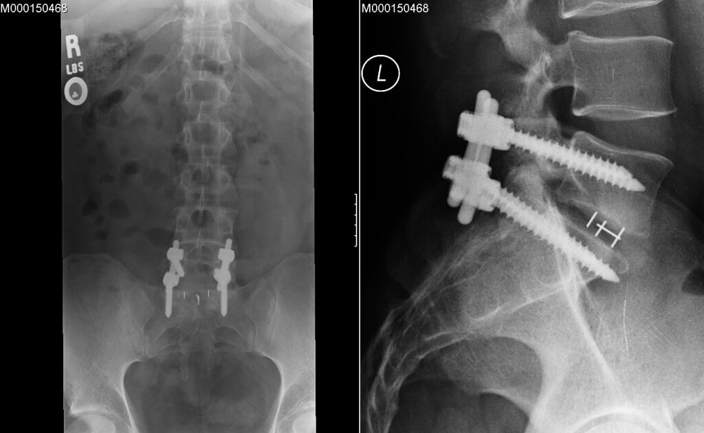 instrumental procedure of Spinal Fusion Surgery