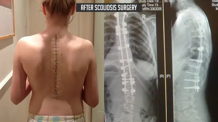 After Scoliosis Surgery