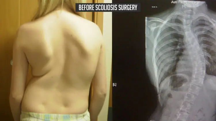 Before Scoliosis Surgery
