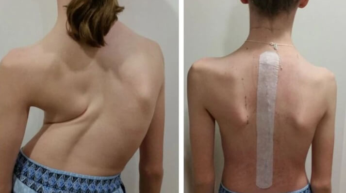 Before and After Scoliosis Surgery