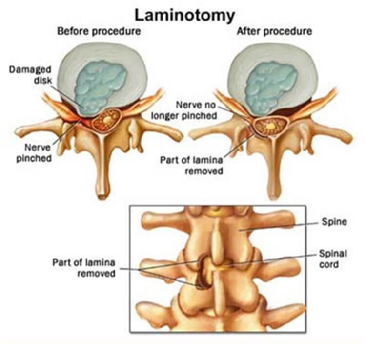 Is a lumbar discectomy the same as a laminectomy?