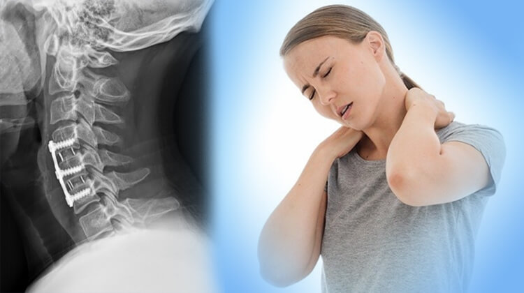 How bad is pain after cervical fusion surgery?