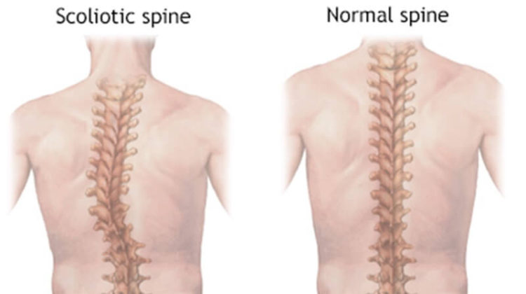 Scoliosis Surgery Before and After