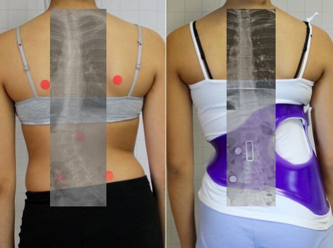 Before and After Thoracolumbar Scoliosis Treatment