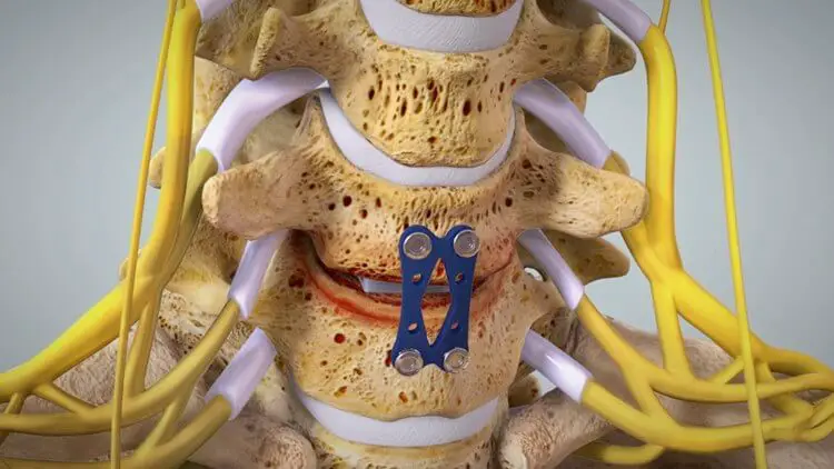 cervical-spine-surgery-success-rate-should-you-opt-for-it