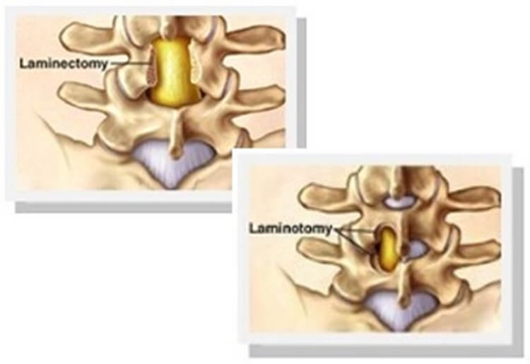 Laminotomy Vs Laminectomy Which One To Choose 