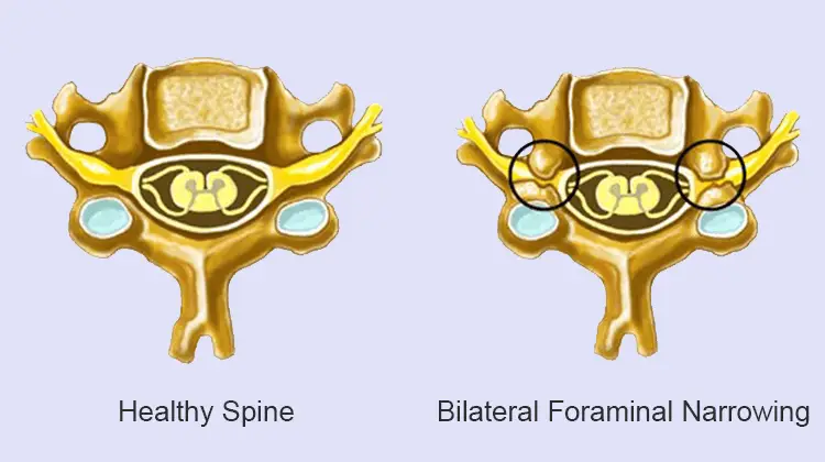 Bilateral-Foraminal-Narrowing