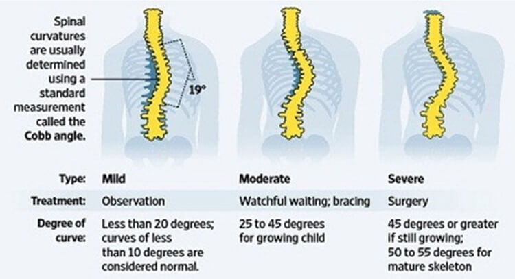 Mild Moderate and Severe Scoliosis