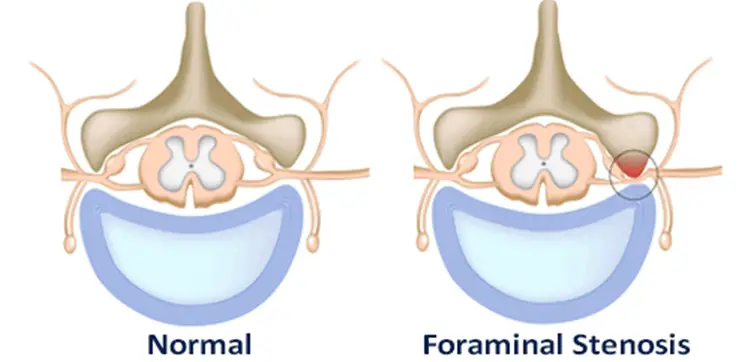 Foraminal-Stenosis-or-Foraminal Narrowing