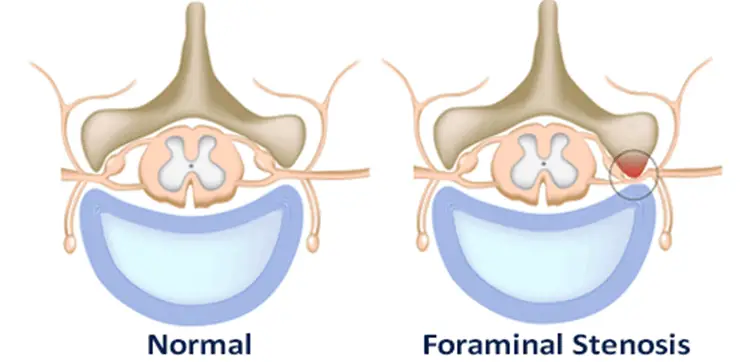 foraminal-stenosis-or-foraminal-narrowing-all-you-need-to-know