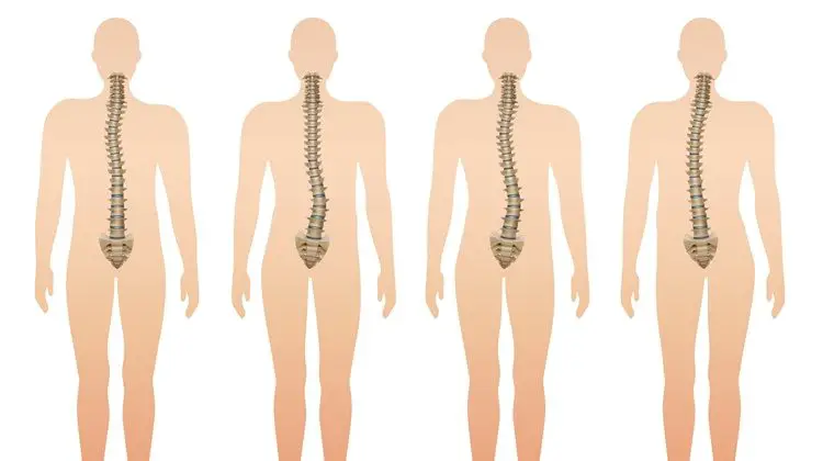 scoliosis-types