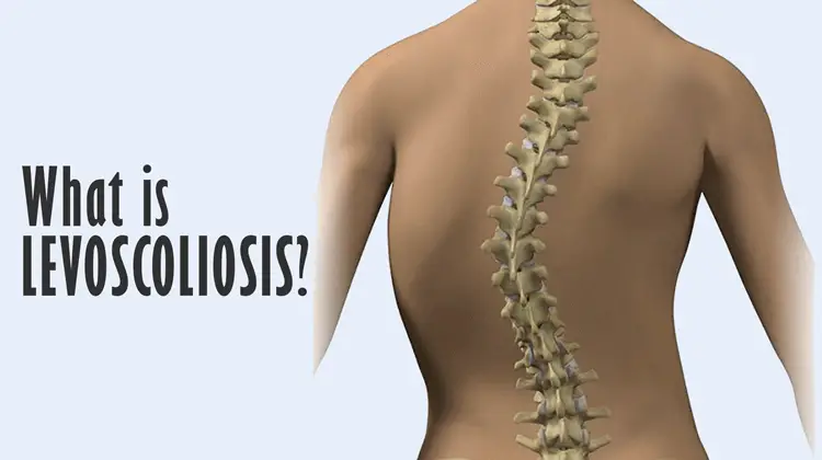what is Levoscoliosis