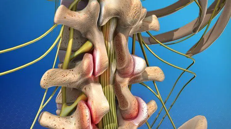 Post-laminectomy Syndrome: Symptoms, Causes & Management