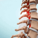 Spinal Box Spinal Fusion Cages: Types, Procedure, and Recovery